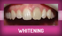 Whitening