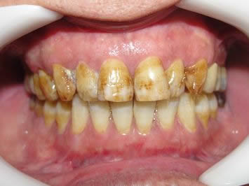 Blanqueamiento dental Rosario antes